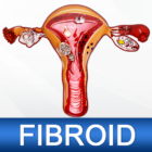 Uterine Fibroid Treatment Help Pro